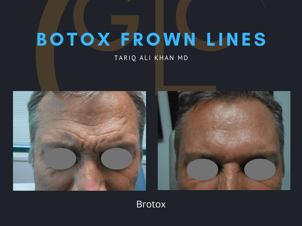 Gentle Care Laser Tustin Before and After picture - Botox