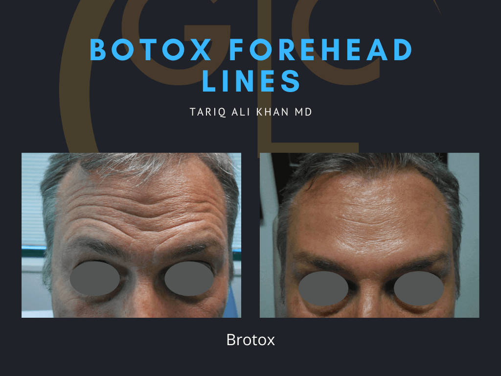 Gentle Care Laser Tustin Before and After picture - Botox