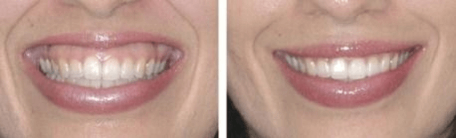 gummy smile treatment orange county