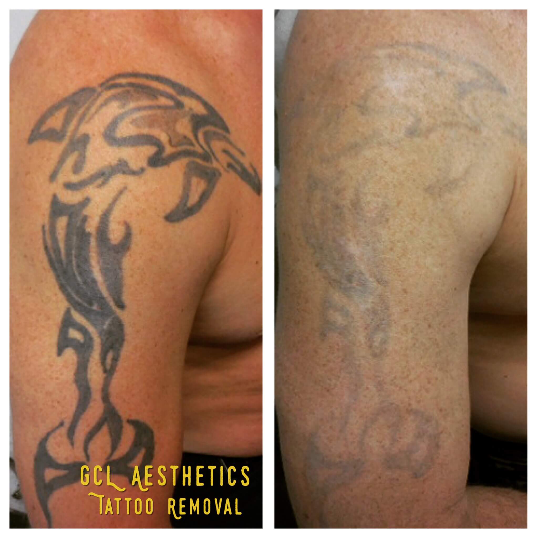 Tattoo Removal | Gentle Care Laser Aesthetic