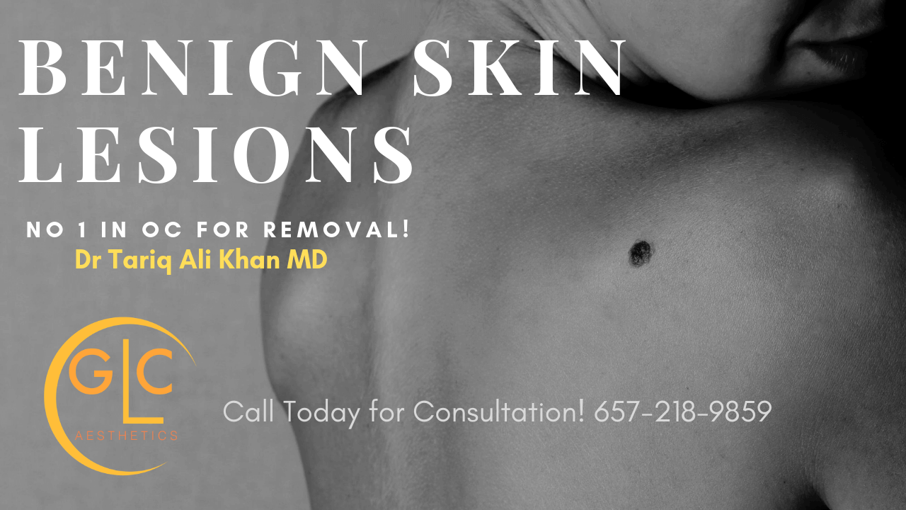benign skin lesions removal Gentle care Laser aesthetics