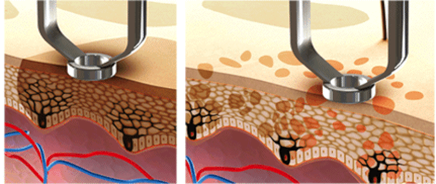 melasma gentle laser care aesthetics tustin california